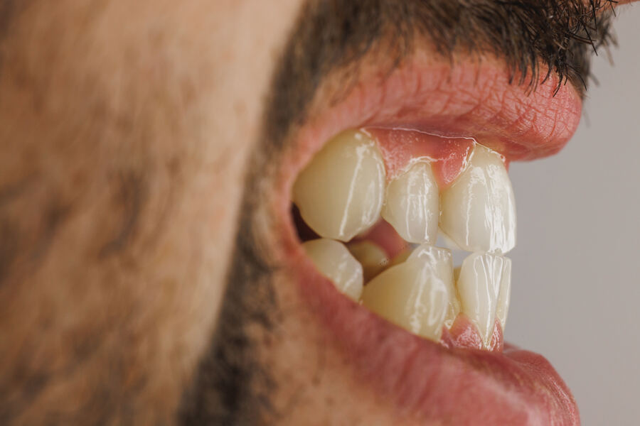 Before dental crown