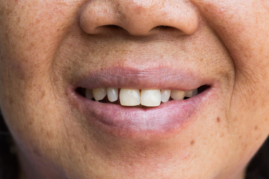 Before dental implant