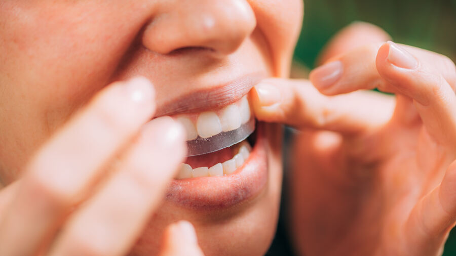 After invisalign