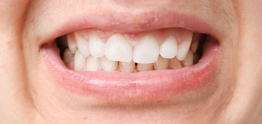 Before invisalign