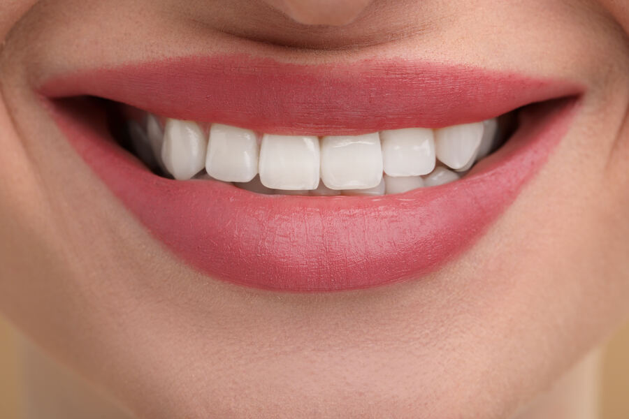 After porcelain veneers