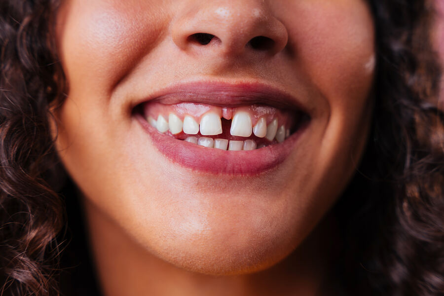 Before porcelain veneers