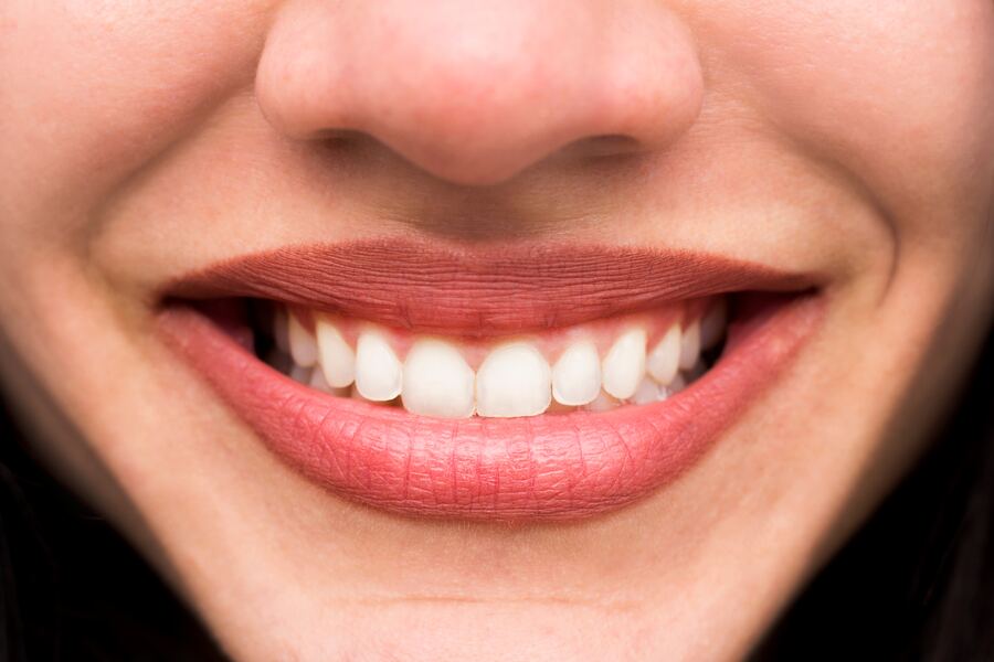 After teeth whitening