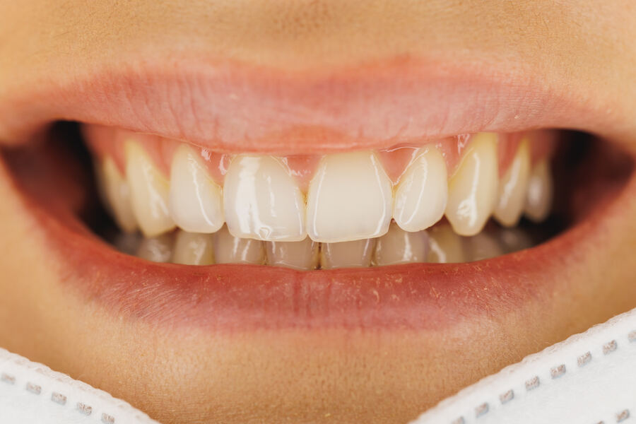 Before teeth whitening